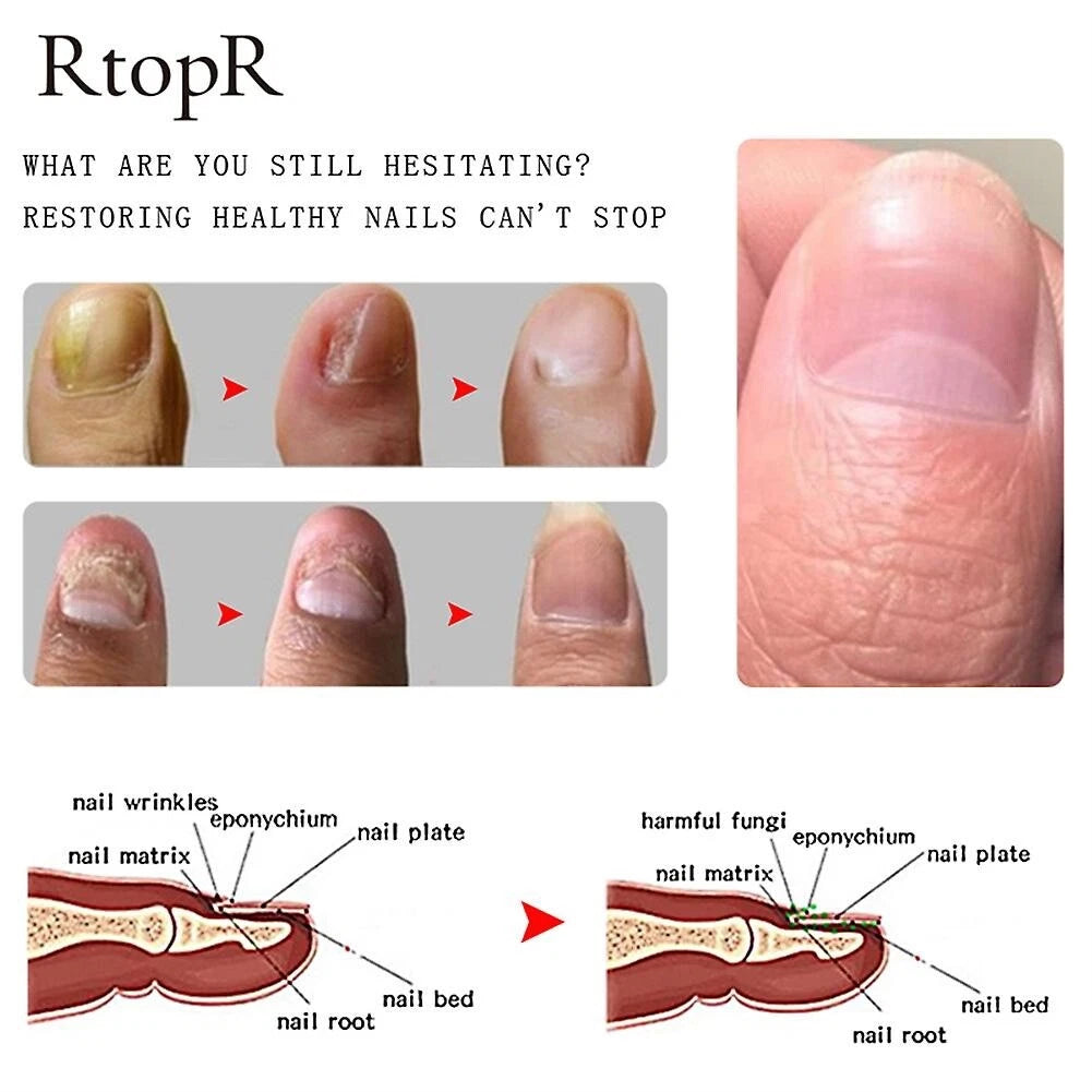 RtopR® 3 in 1 (Nail Repairer, Restorer and Strengthener)