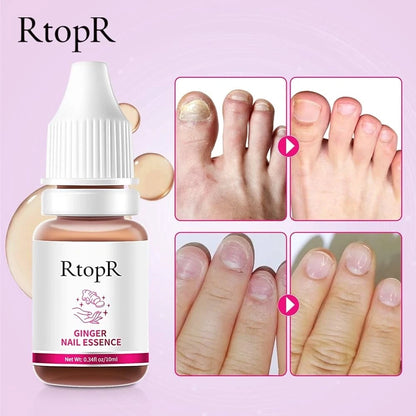 RtopR® 3 in 1 (Nail Repairer, Restorer and Strengthener)