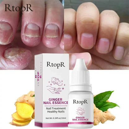 RtopR® 3 in 1 (Nail Repairer, Restorer and Strengthener)